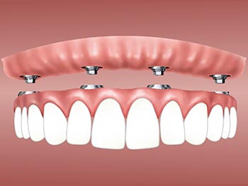 Zahnimplantate können mehrere Zähne ersetzen