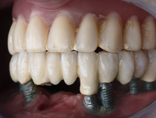 Gebiss mit Zahnimplantaten, wo Zahnfleisch und Knochen stark zurückgegangen sind