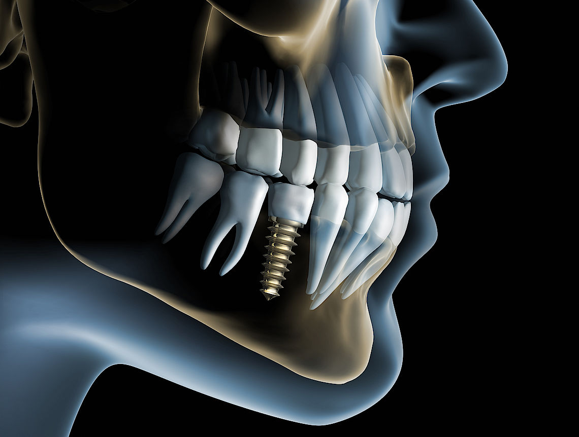 Aufnahme eines Implantatkörpers neben einem Modell eines natürlichen Zahns