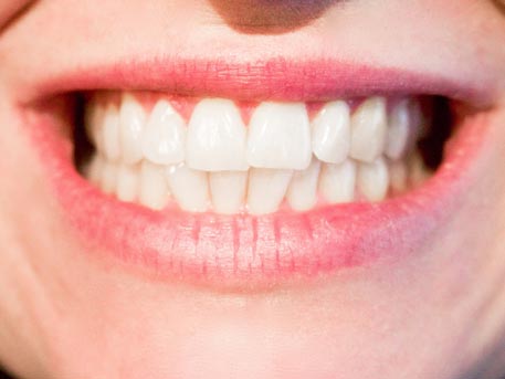 Zahnfehlstellungen auch als Erwachsener korrigieren lassen