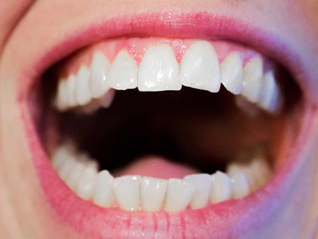 Zahnfleischentzündung an Zahn und Zahnimplantat