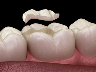 Grafische Darstellung einer zahnfarbenen Zahnfüllung, die im beschädigten Zahn platziert wird.