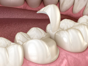Modell eines Inlays für einen Zahn mit kariösem Defekt