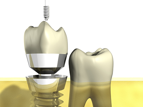 Grafische Darstellung eines Zahnimplantats und natürlichen Zahns