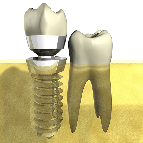 Zahnprothese: Arten, Ziele und Ursachen