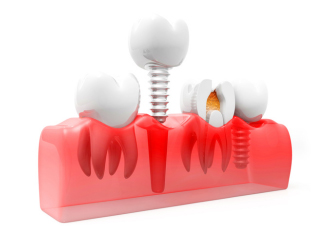 Grafik mit zwei Zahnimplantaten, eines sitzt fest und eines kommt heraus