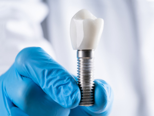 Nahaufnahme eines Zahnimplantat-Modells zur Verdeutlichung der Zahnexplantation von einem Zahnchirurgen mit blauem sterilem Handschuh gehalten