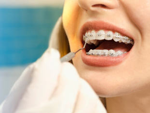 Einer jungen Frau wird die Zahnspange zum Zahnarzt angepasst