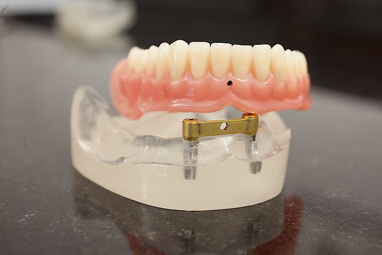 Modell eines Zahnimplantats für den Unterkiefer